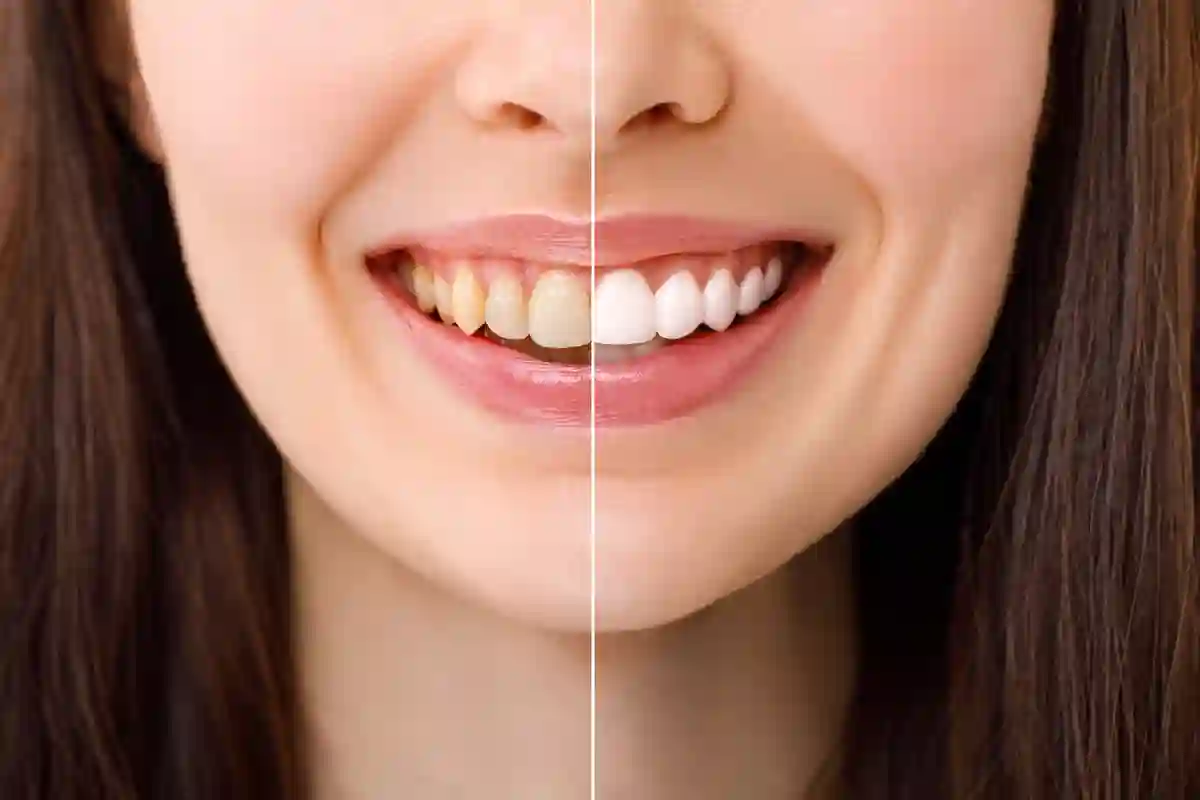 L’Ingrediente Definitivo per Avere Denti Più Bianchi e un Sorriso Perfetto